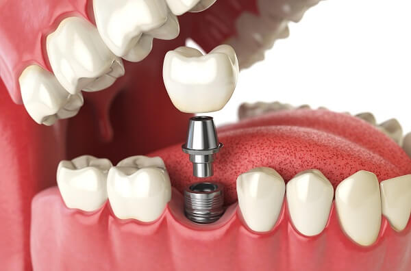 Implant - phương pháp cấy ghép răng giả hiện đại
